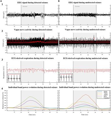 Vagus nerve electroneurogram-based detection of acute kainic acid induced seizures